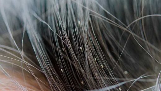 Arti Mimpi Banyak Kutu